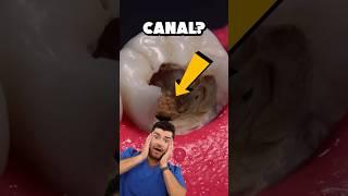 Root Canal Explained !?