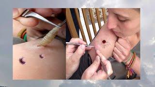 Mangoworm Bot fly removed from Woman