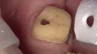 Case of the Week: Dealing with Path of Insertion Troubles