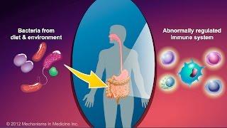 What is Crohn's Disease?