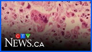 Four more measles cases in Brant and Norfolk County