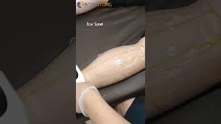 Newangie Diode Laser Hair Removal Machine Treatment