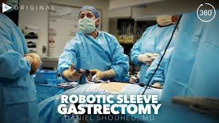 Robotic Sleeve Gastrectomy by Dr. Daniel Shouhed | Case Trailer