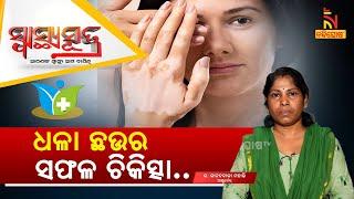 ଲଗାନ୍ତୁ ଏହି ଜିନିଷ, ଧଳାଛଉ ହେବ ମୂଳରୁ ସଫା |Treatment for Vitiligo | Dr Kananbala Mohanty |SwasthyaSutra