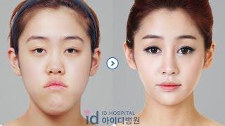 [id hospital review] before and after plastic surgery in korea(v-line, eye, nose and fat graft)