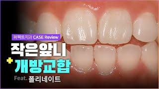 작은 앞니&개방교합 마취없이 무삭제폴리네이트| 0.1mm 최소삭제 CASE