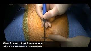 Deep Dive Into Aortic Surgery Mini-Access David Procedure—Endoscopic Assessment of Valve Competency