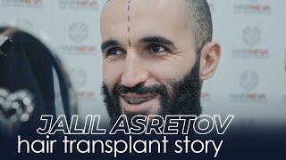 Jalil Asretov's Hair Transplant Story | HairNeva Premium Hair Transplantation