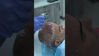 Best Hair Transplant Results in Miami | Care4Hair