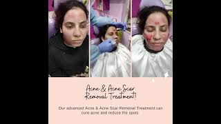 Acne & Acne Scar Treatment | Spotless Skin | Skin Care | Cosmogene | Kolkata