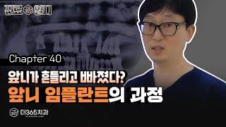 흔들리고 빠진 앞니, 임플란트 치료 과정은? | 【더365치과】 진료일지 #40