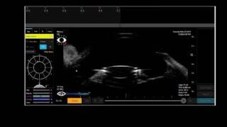 UBM of Axial Shift AD-IOL with Zonular Capture Haptics