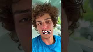 My Backyard Rollercoaster Gave me Poison Oak… #Shorts