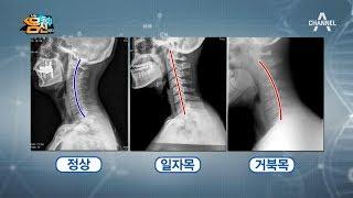 [예능] 나는 몸신이다 212회_190129_만성통증 · 치매 · 소화불량의 원인, 몸이 보내는 경고 '거북목'