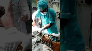 #ilizarov external fixator removal #orthopaedics #surgery #shorts #viralshort #drrony