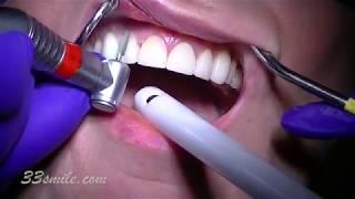 Replacing old porcelain dental veneers before and after