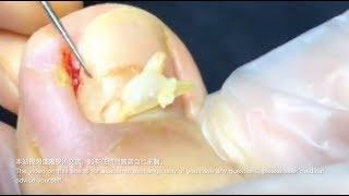 甲溝炎-paronychia 베트남/realxing video 231/涷甲/嵌甲/Ingrown nail treatment（how to fix ingrown toenail）