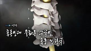 [명의 의학백과] 후종인대 골화증 수술법, 후궁 성형술