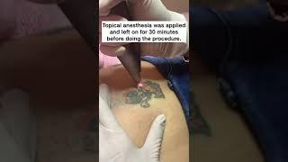 Laser Tattoo Removal #shorts