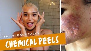 Chemical Peels : All Your Questions Answered | Can Brown People Get Skin Peels? | Esthetician Taj