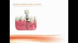 Biohorizons: Dental Implants