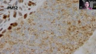 Tip-42;MMR Stains in Endometrial Carcinoma