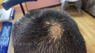 ALOPECIA AREATA | Dr. SHWETA PATIL #alopecia