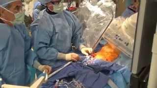 CoreValve Procedure I El Camino Hospital