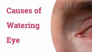 Causes of Watering Eyes - Optometry Club