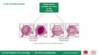 Valutazione ecocardiografica transtoracica della Bicuspidia Aortica