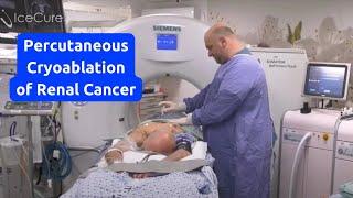 Percutaneous Cryoablation of Renal Cancer using the ProSense System (Short)