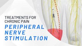 Peripheral Nerve Stimulation - What You Need To Know