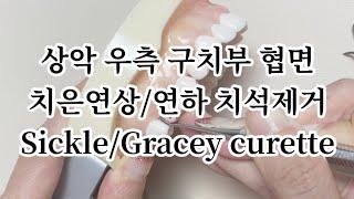 상악 우측 구치부 협면 10번대 구치부 치은연상 치은연하 치석제거 시클 그레이시 큐렛