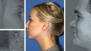 Rhinoplasty in Utah - Bitner Facial Plastic Surgery