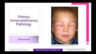 Primary Immunodeficiency Pathology | Comprehensive Guide & Step 1 Review | Pathology Step 1 USMLE