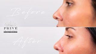 Plasma Fibroblast - Prive Academy - Nose Contouring Technique