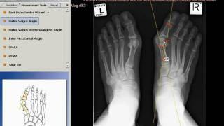 TraumaCad - Hallux Valgus Angle