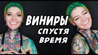 Виниры. Отзыв спустя время. Моя история