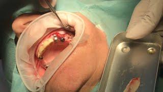 Osseodensification Maxillary Sinus Autograftιng full video