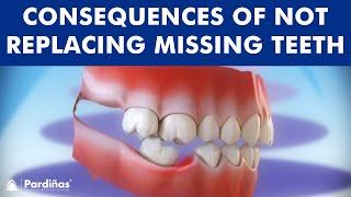 Consequences of not replacing missing teeth ©