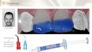 Reshaping Tooth Anatomy with Vit-l-escence