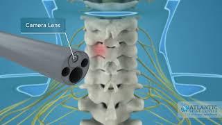 What is Endoscopic Posterior Cervical Discectomy and Foraminotomy? @AtlanticSpineCenter