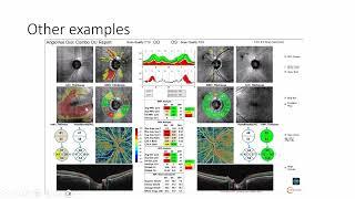 Unlocking the Potential of OCT-Angiography in Glaucoma with Dr. Mike Cymbor