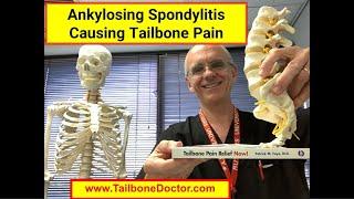 Ankylosing Spondylitis Causing Coccyx Pain, Tailbone Pain, Coccydynia