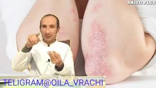 ПСОРИАЗ КАСАЛЛИГИ ХАКИДА ФОЙДАЛИ ТАФСИЯЛАР PSORIAZ KASALLIGI