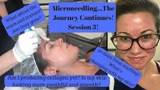 Microneedling Procedure For Acne Scars & Textured Skin: Part Three