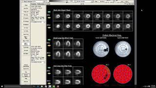 perfusion Imaging Dr Amr Adel