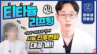 연예인들이 찾는 피부과시술 "TOP1"이 티타늄 리프팅인 이유 (Feat. 실제 시술 과정 포함) | 티타늄리프팅효과 티타늄리프팅부작용