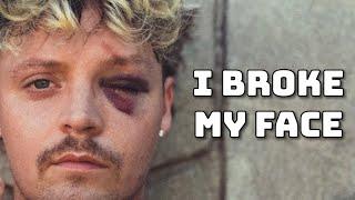 I Broke My Face (LIVE Storytime)