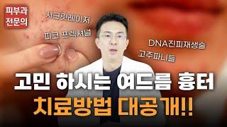 고민하고 계신 여드름 흉터! 이제는 치료할 때 됐죠?